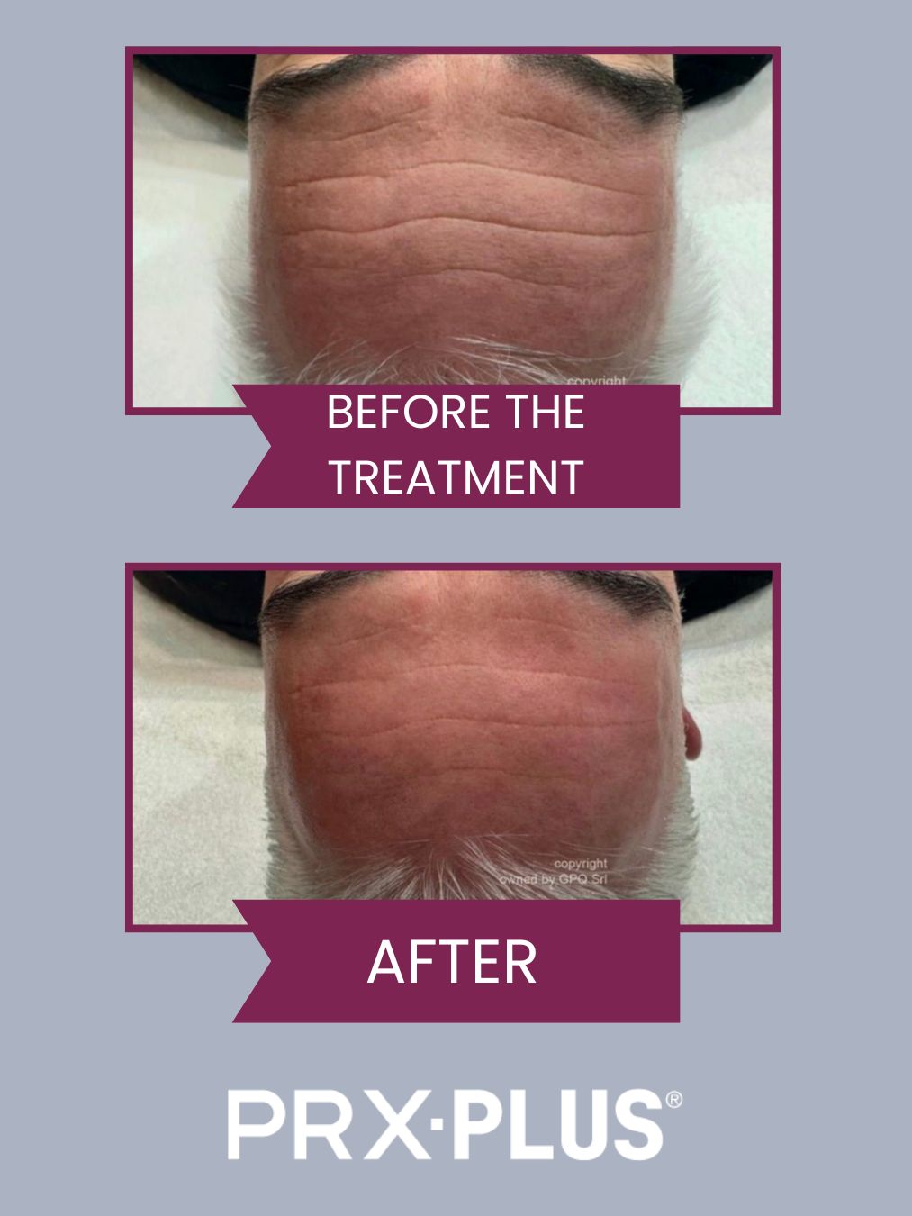 PRX-PLUS Biostimulator